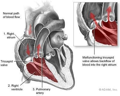Mental Health and Well-being Tricuspid Stenosis